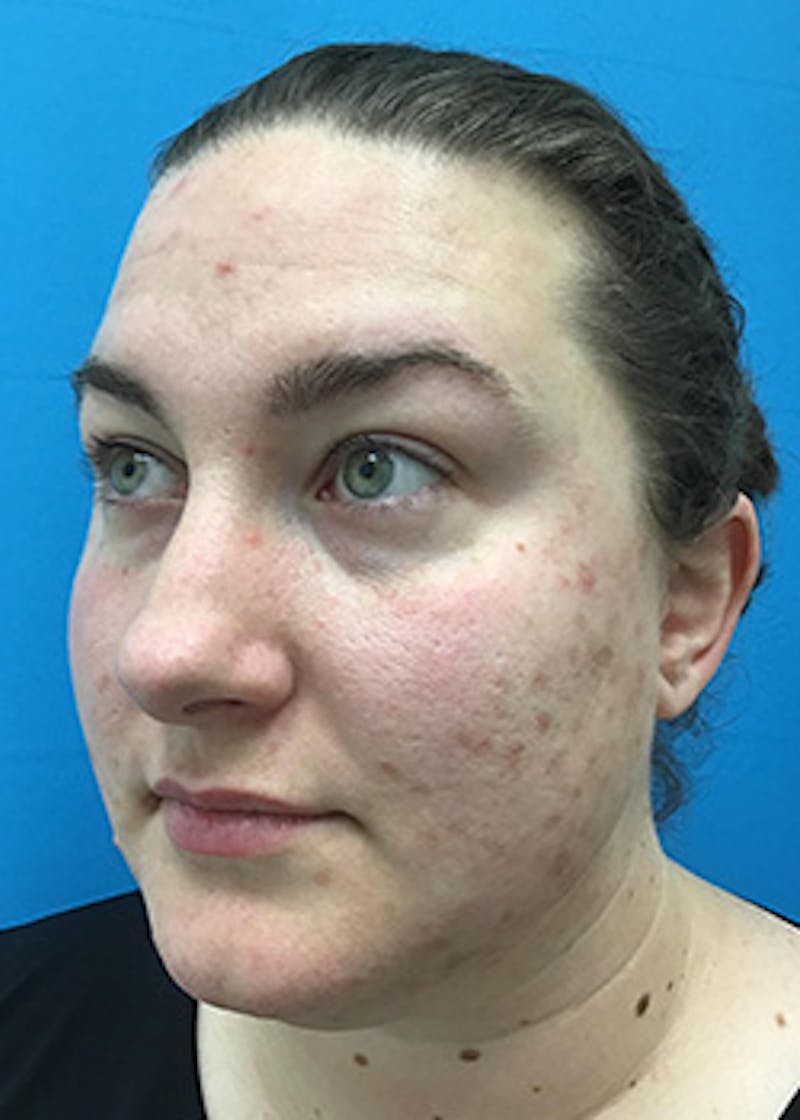 Fillers Before & After Gallery - Patient 147702798 - Image 7