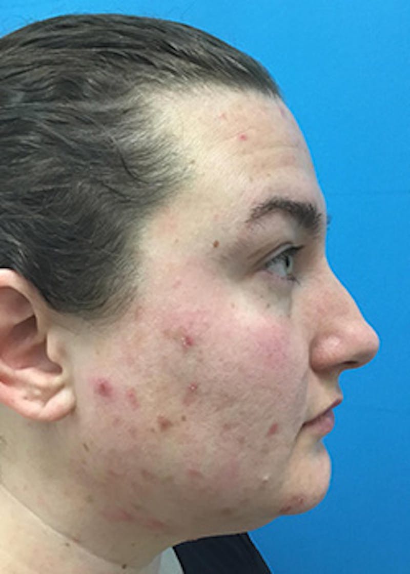 Fillers Before & After Gallery - Patient 147702798 - Image 5
