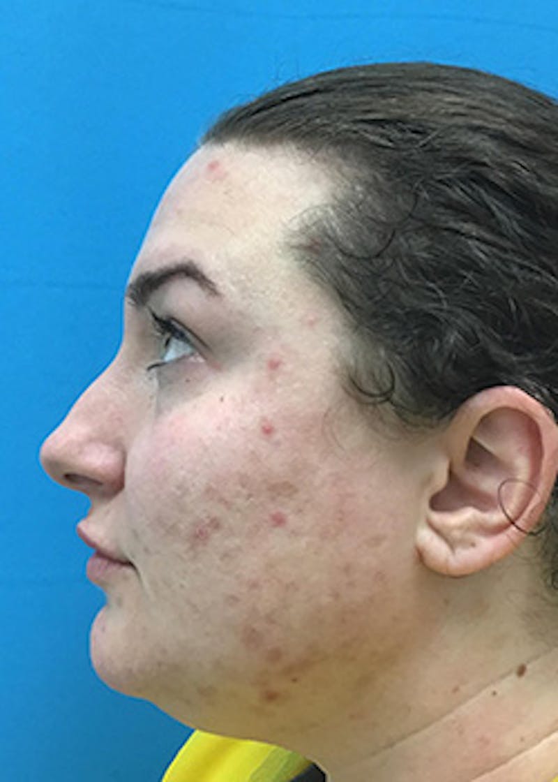 Fillers Before & After Gallery - Patient 147702798 - Image 10