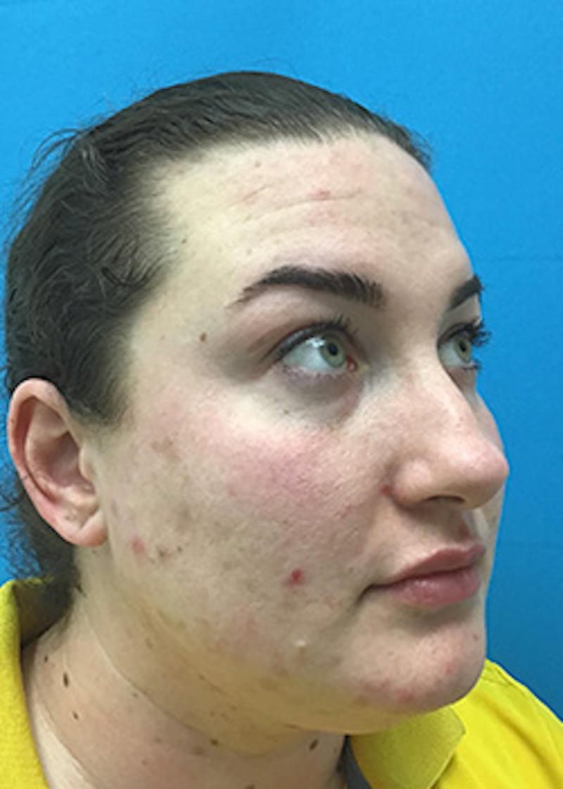 Fillers Before & After Gallery - Patient 147702798 - Image 4