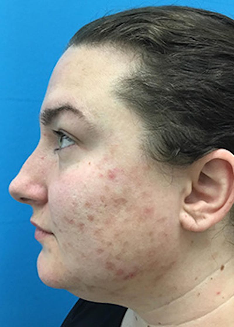 Fillers Before & After Gallery - Patient 147702798 - Image 9
