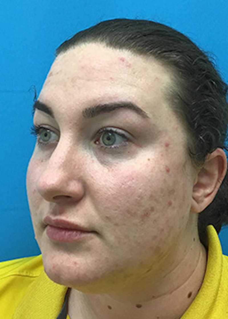 Fillers Before & After Gallery - Patient 147702798 - Image 8