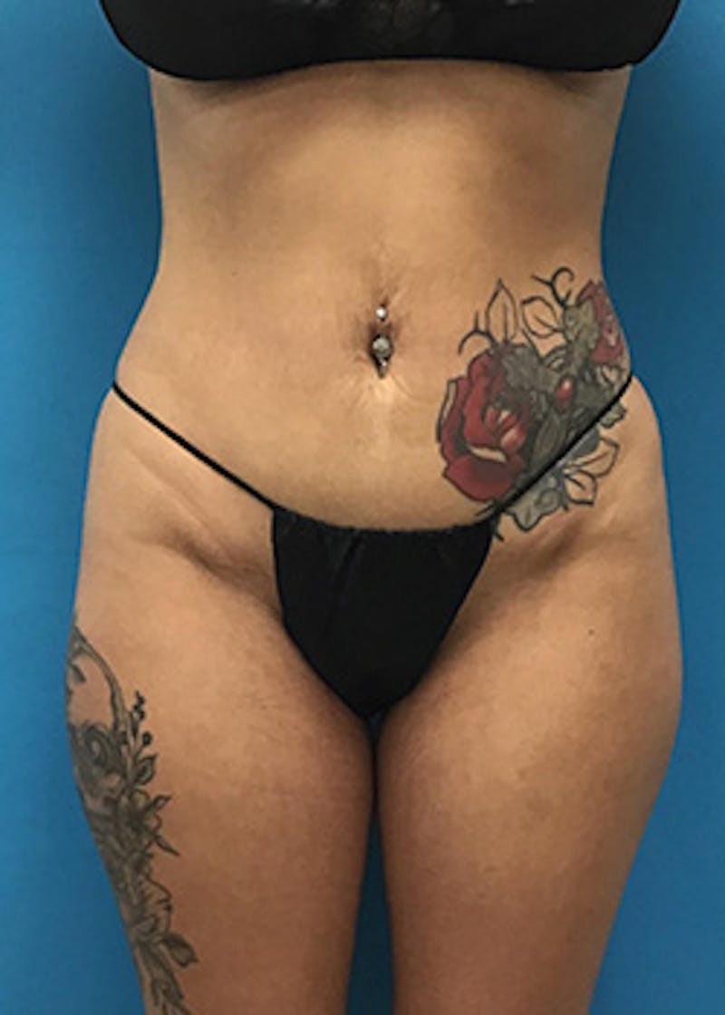 Liposuction Before & After Gallery - Patient 148410566 - Image 1