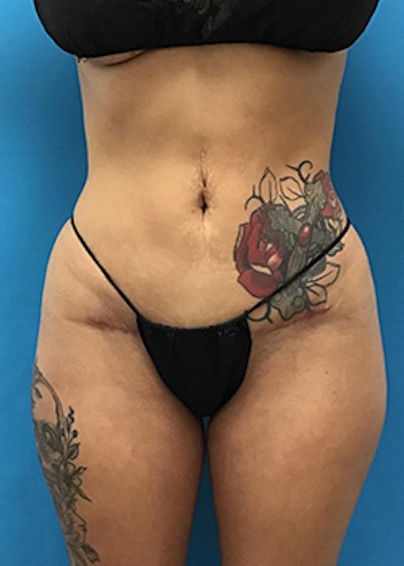 Brazilian Butt Lift Before & After Gallery - Patient 148410560 - Image 2