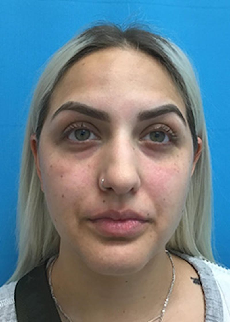 Fillers Before & After Gallery - Patient 148410553 - Image 1