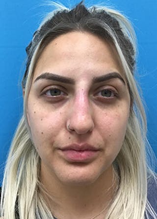 Fillers Before & After Gallery - Patient 148410553 - Image 2