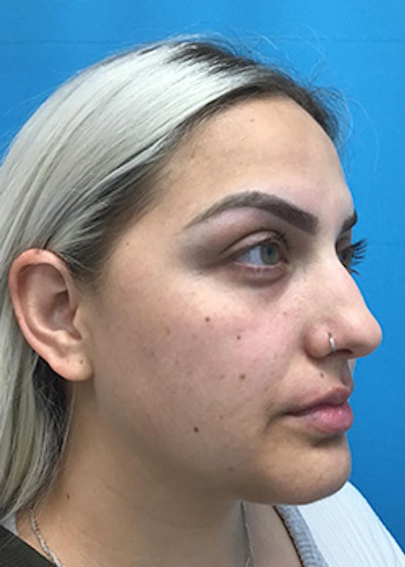 Fillers Before & After Gallery - Patient 148410553 - Image 3