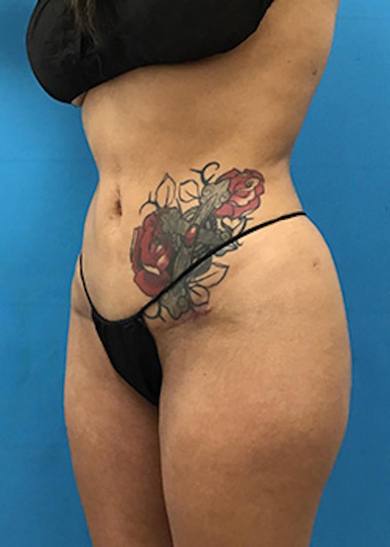 Brazilian Butt Lift Before & After Gallery - Patient 148410560 - Image 10