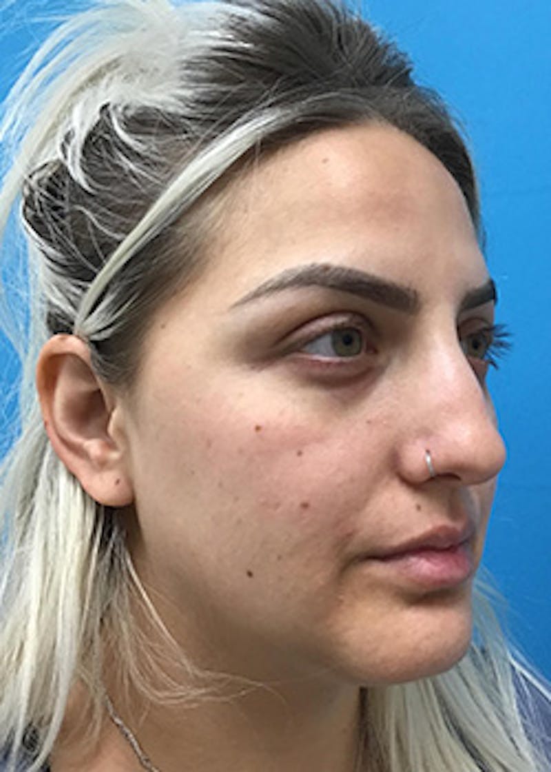 Fillers Before & After Gallery - Patient 148410553 - Image 4
