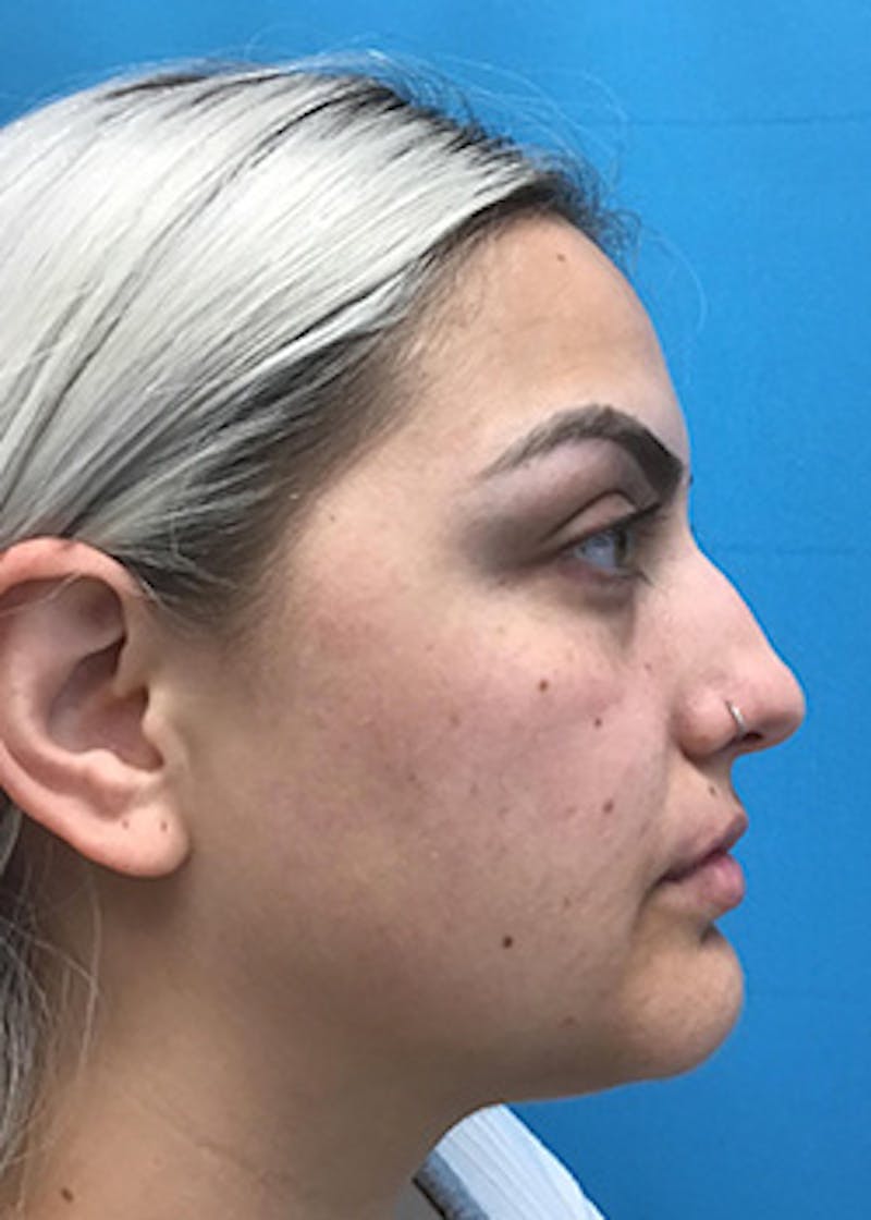 Fillers Before & After Gallery - Patient 148410553 - Image 5