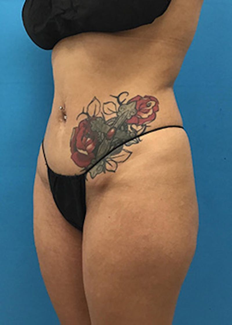 Liposuction Before & After Gallery - Patient 148410566 - Image 9