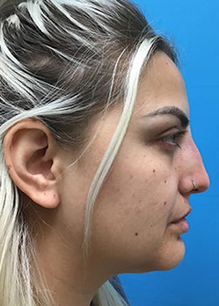 Fillers Before & After Gallery - Patient 148410553 - Image 6