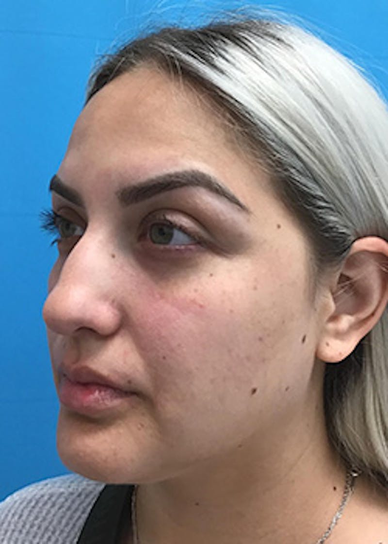 Fillers Before & After Gallery - Patient 148410553 - Image 7
