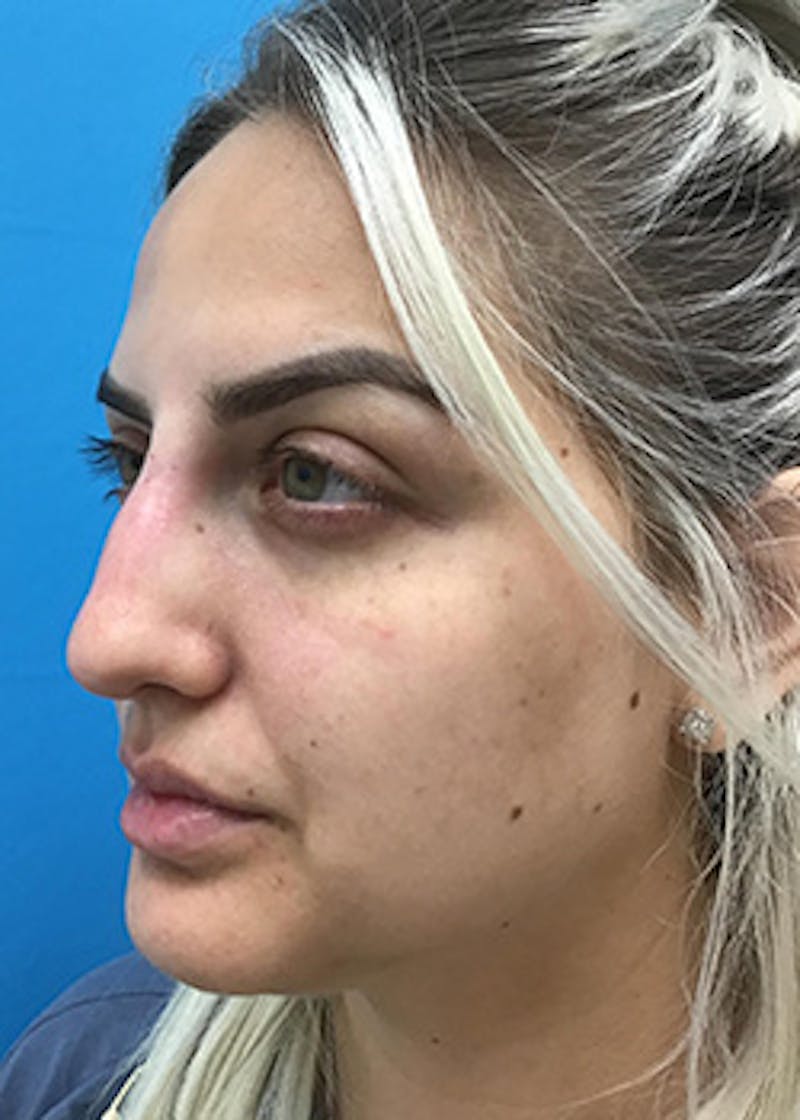 Fillers Before & After Gallery - Patient 148410553 - Image 8