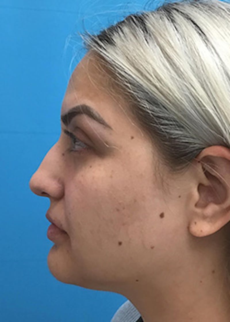 Fillers Before & After Gallery - Patient 148410553 - Image 9