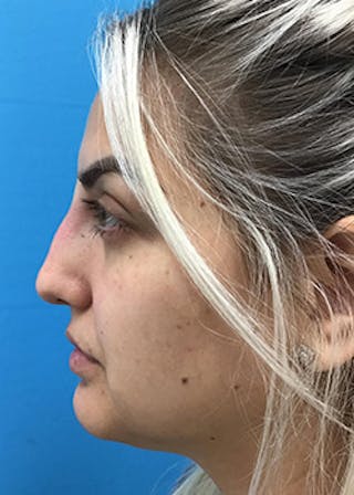 Fillers Before & After Gallery - Patient 148410553 - Image 10