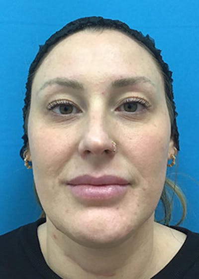 Chemical Peel Before & After Gallery - Patient 148410567 - Image 1