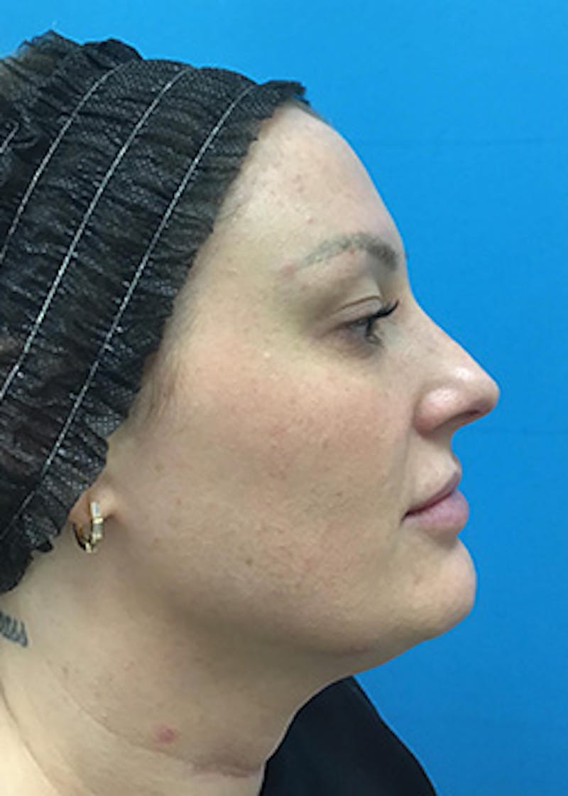 Chemical Peel Before & After Gallery - Patient 148410567 - Image 3