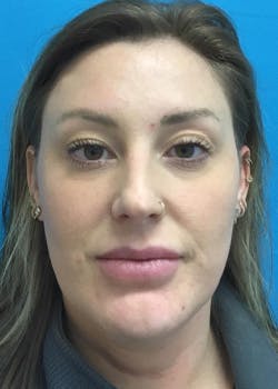 Before & After Photos of Chemical Peels in Friendswood & League City, TX