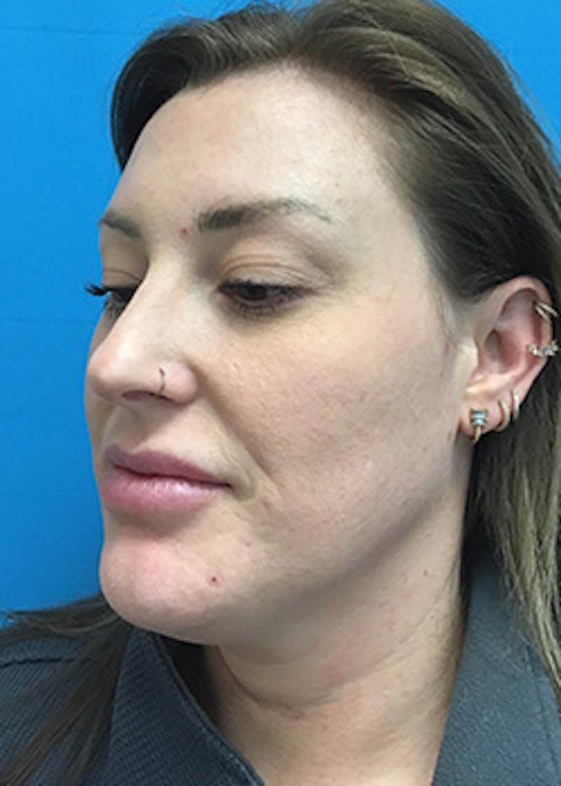 Chemical Peel Before & After Gallery - Patient 148410567 - Image 6