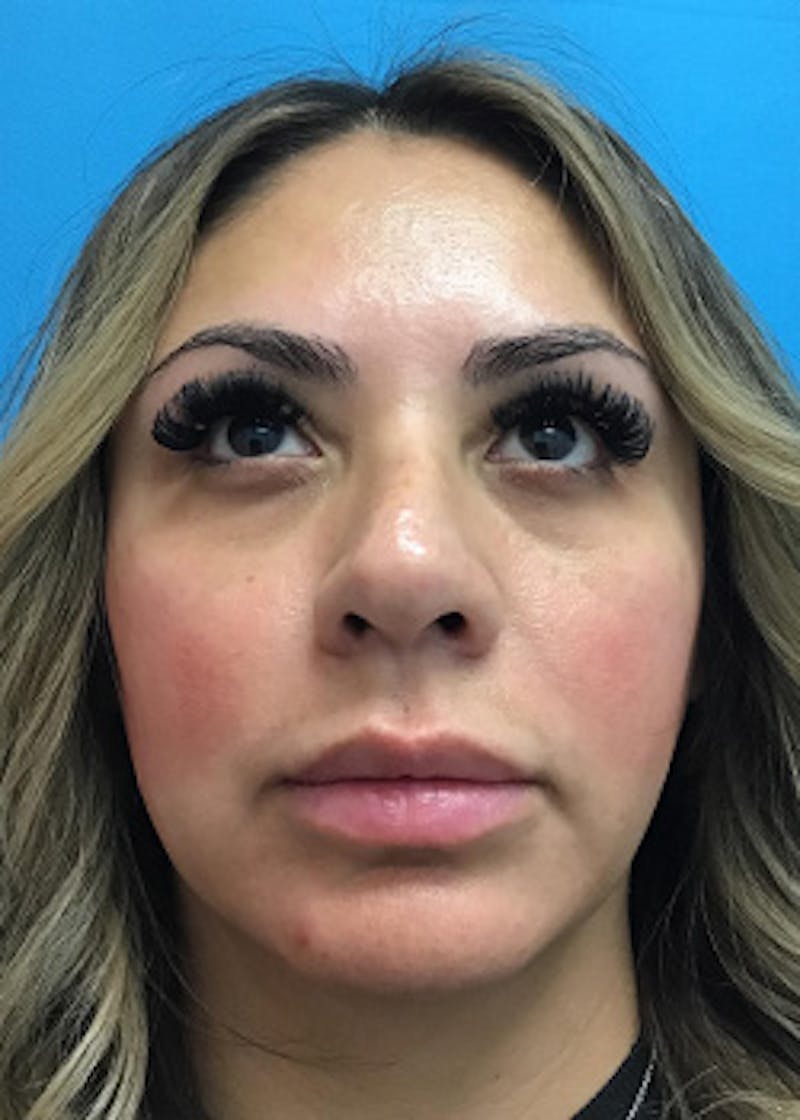 Fillers Before & After Gallery - Patient 148410554 - Image 1