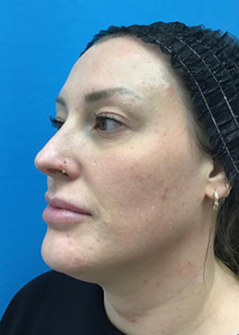 Chemical Peel Before & After Gallery - Patient 148410567 - Image 5