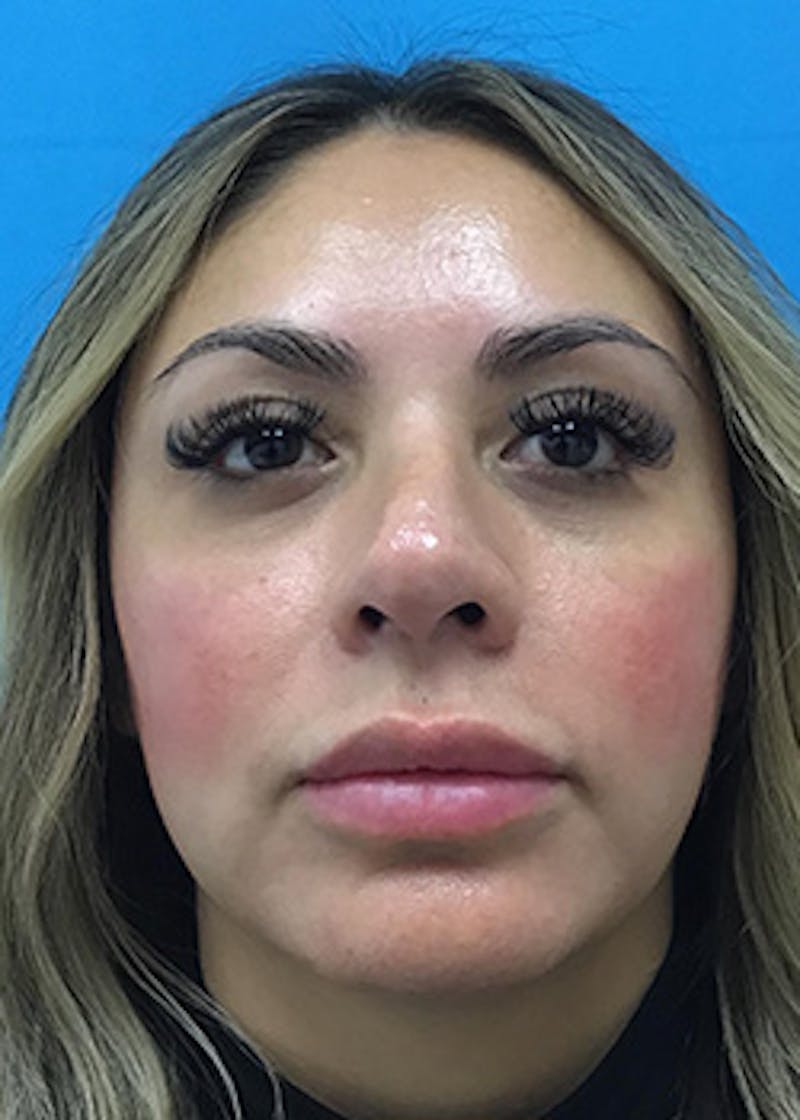 Fillers Before & After Gallery - Patient 148410554 - Image 2