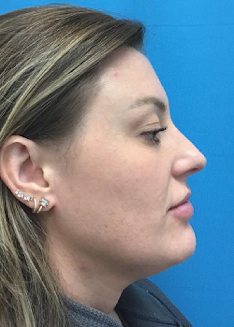 Chemical Peel Before & After Gallery - Patient 148410567 - Image 4