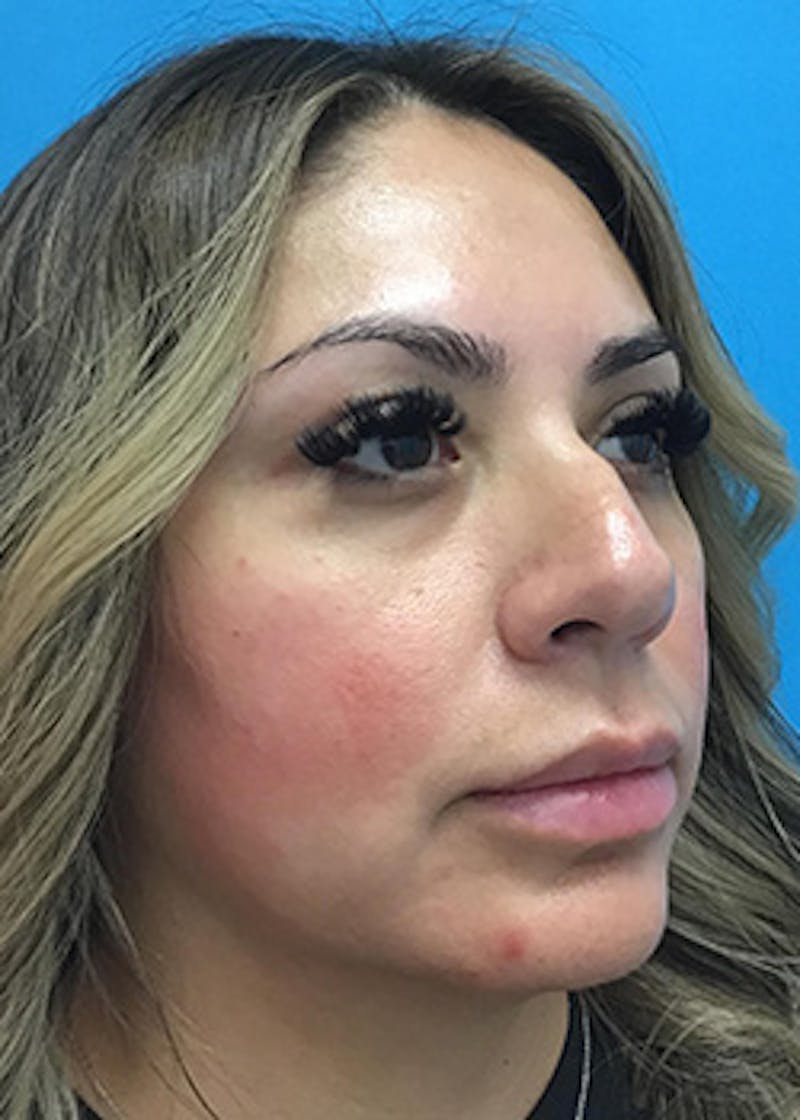 Fillers Before & After Gallery - Patient 148410554 - Image 3