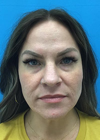 FaceTite Before & After Gallery - Patient 148410569 - Image 1