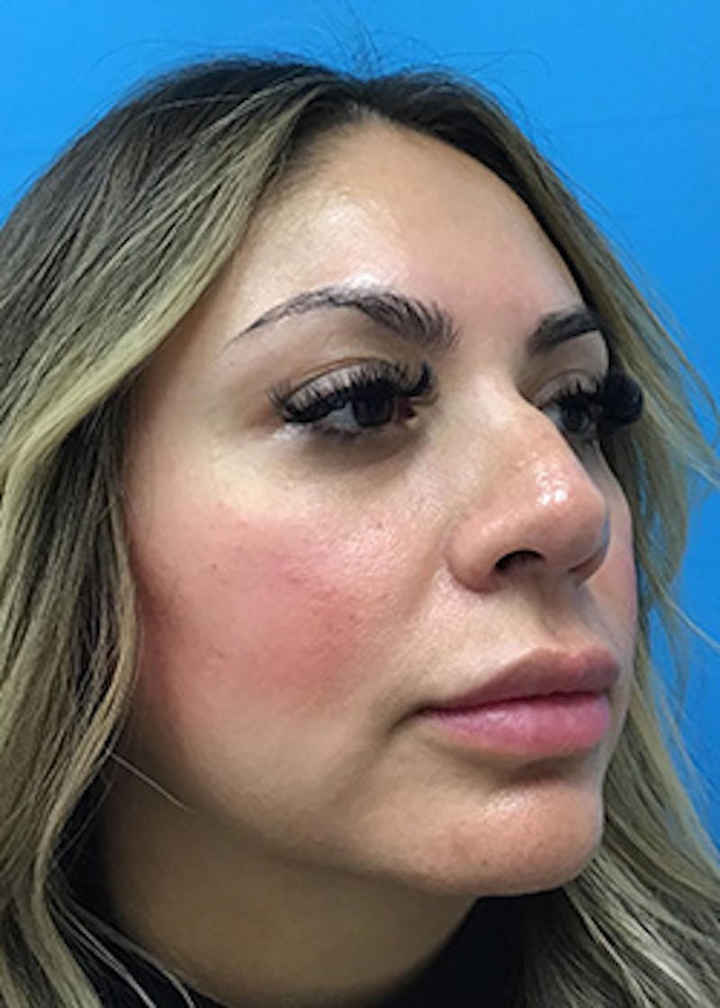 Fillers Before & After Gallery - Patient 148410554 - Image 4