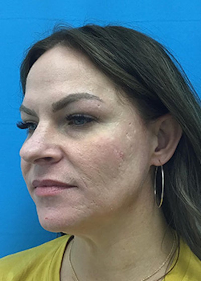FaceTite Before & After Gallery - Patient 148410569 - Image 3