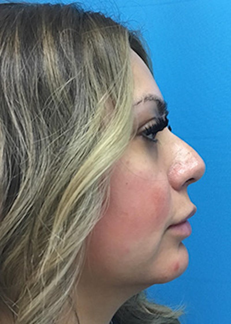 Fillers Before & After Gallery - Patient 148410554 - Image 5