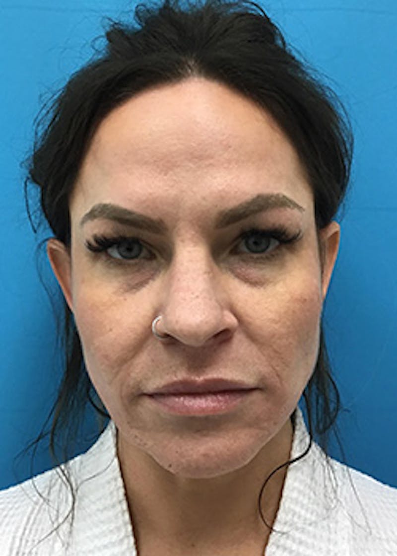 FaceTite Before & After Gallery - Patient 148410569 - Image 2