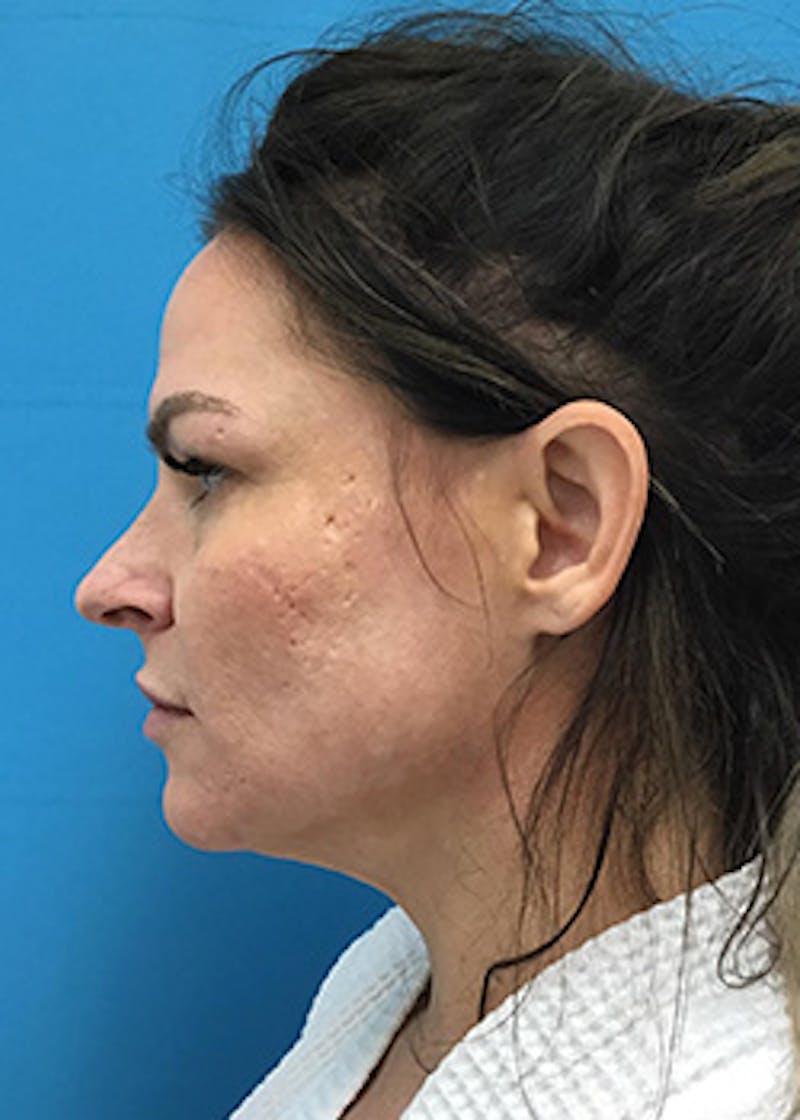 FaceTite Before & After Gallery - Patient 148410569 - Image 6