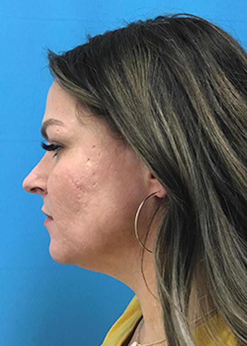 FaceTite Before & After Gallery - Patient 148410569 - Image 5