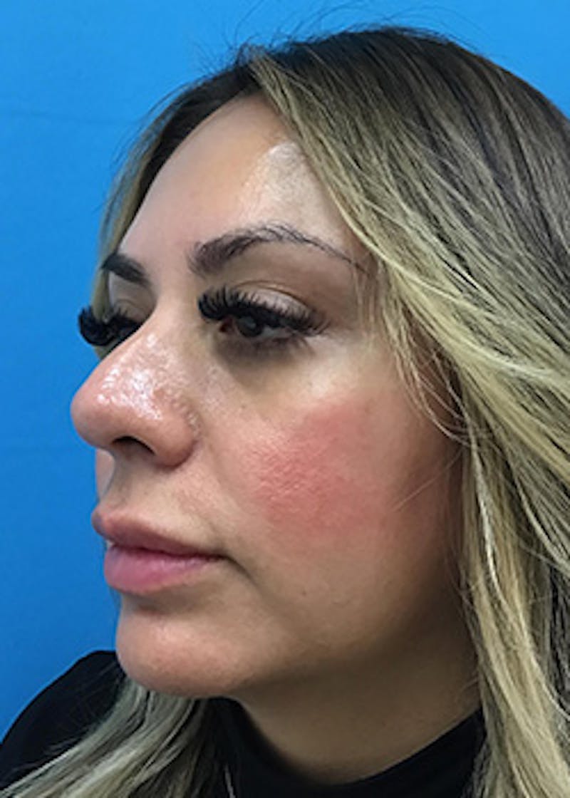 Fillers Before & After Gallery - Patient 148410554 - Image 8