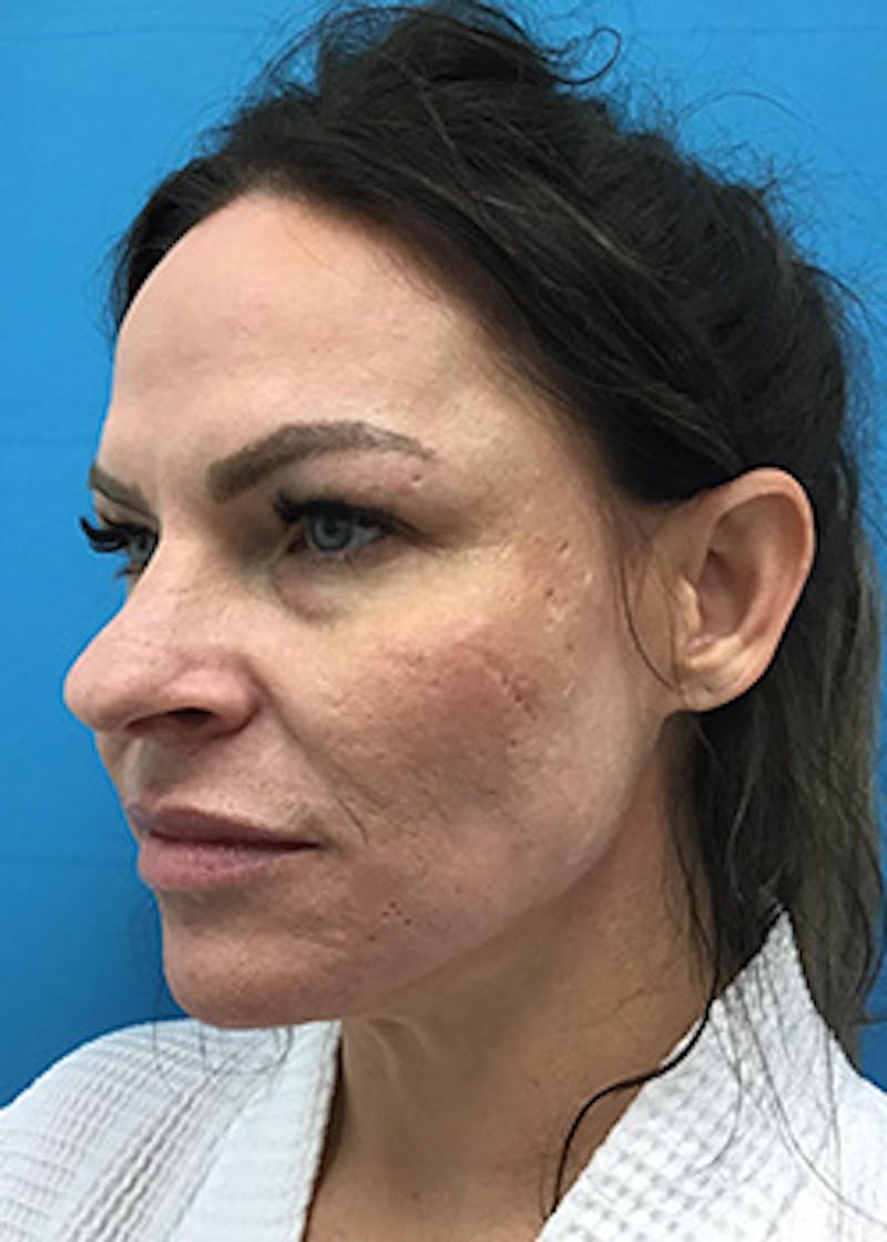 FaceTite Before & After Gallery - Patient 148410569 - Image 4