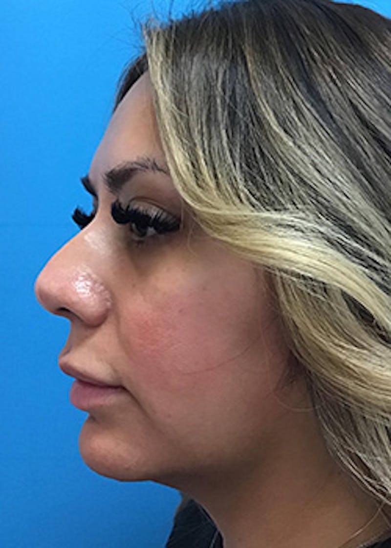 Fillers Before & After Gallery - Patient 148410554 - Image 9
