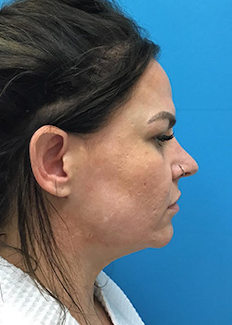 FaceTite Before & After Gallery - Patient 148410569 - Image 8