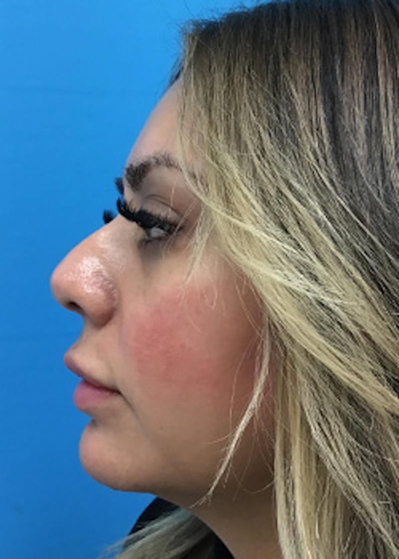 Fillers Before & After Gallery - Patient 148410554 - Image 10