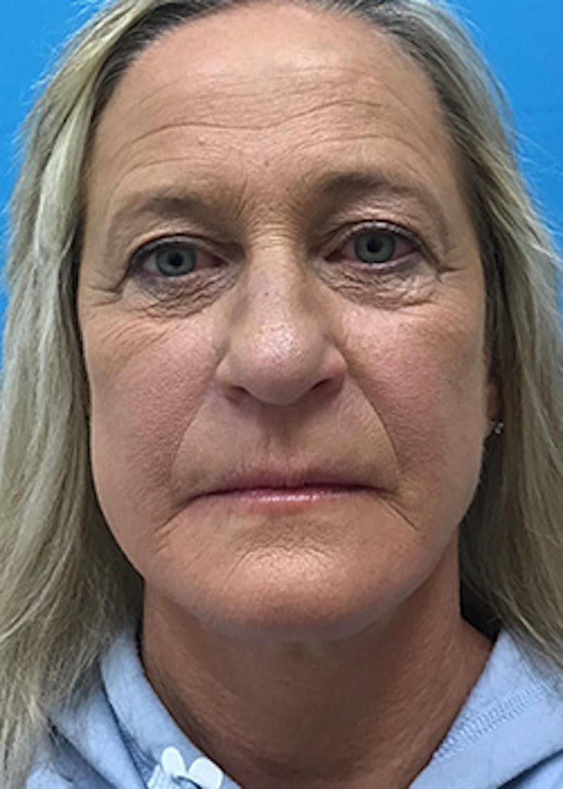 Fillers Before & After Gallery - Patient 148410555 - Image 1