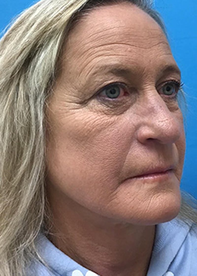 Fillers Before & After Gallery - Patient 148410555 - Image 3