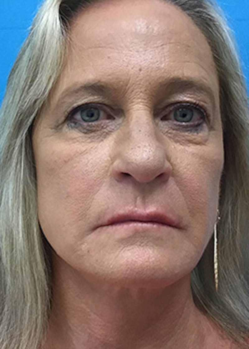 Fillers Before & After Gallery - Patient 148410555 - Image 2