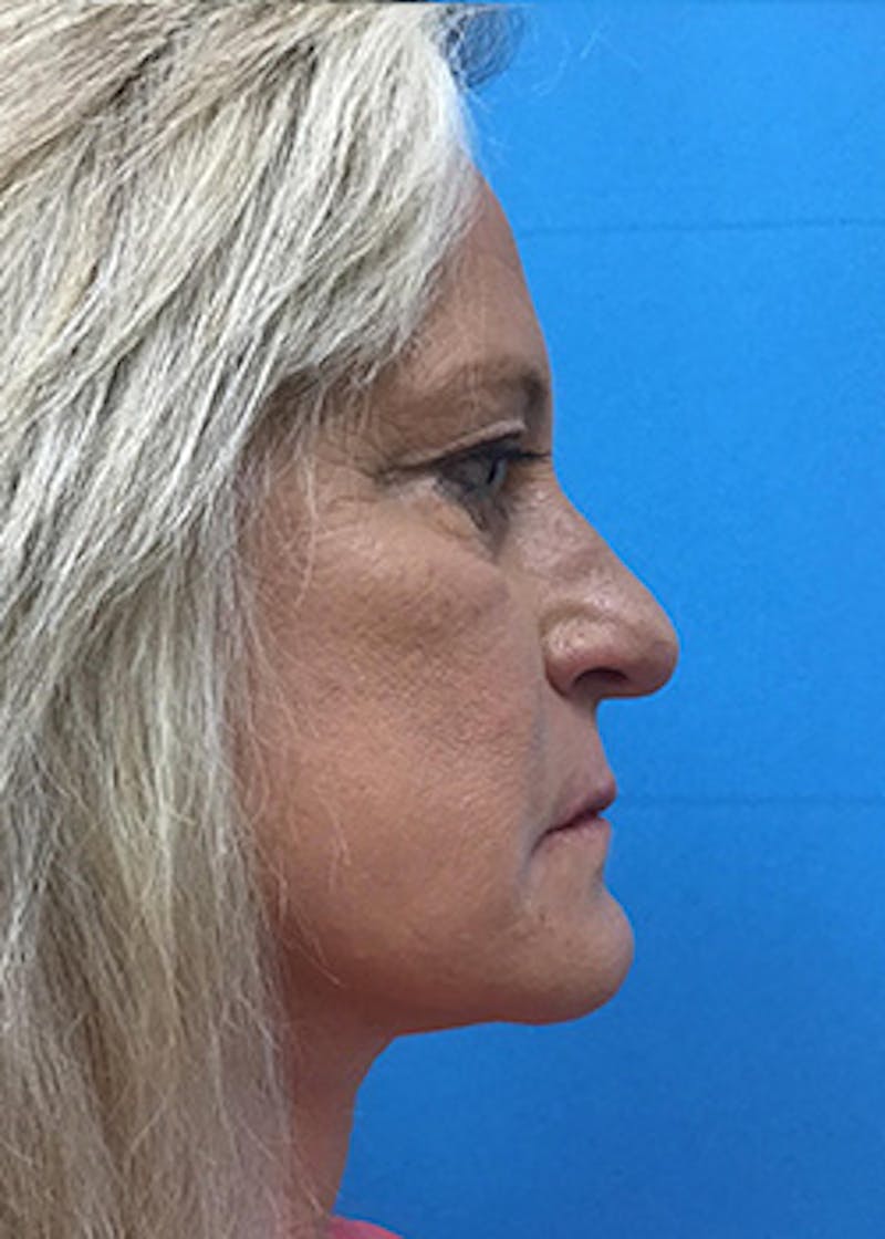 Fillers Before & After Gallery - Patient 148410555 - Image 6