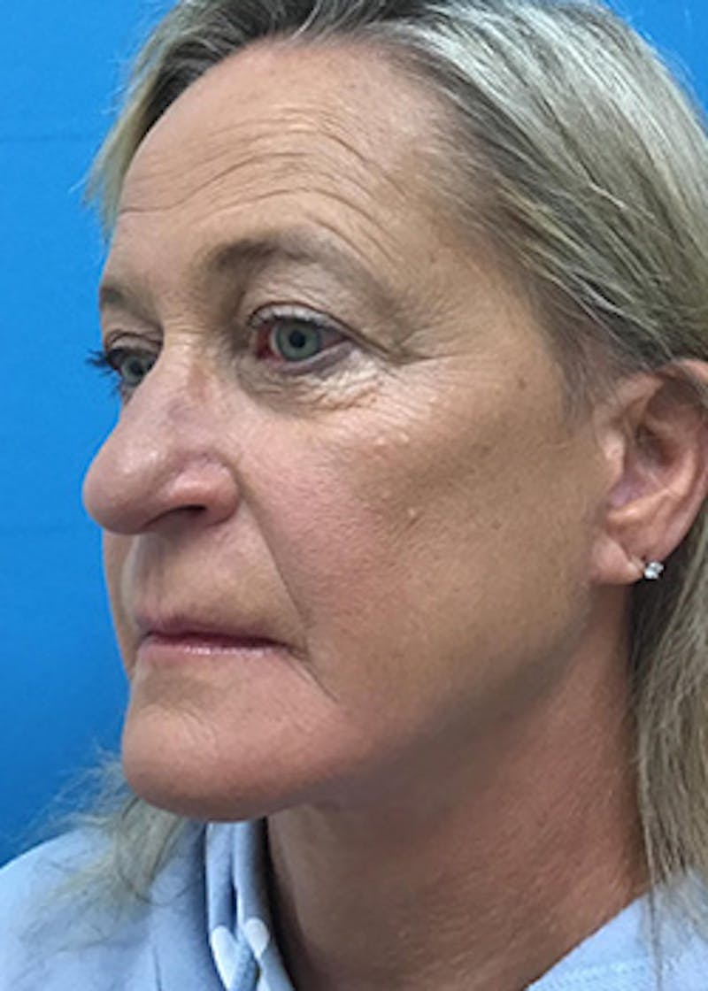 Fillers Before & After Gallery - Patient 148410555 - Image 7