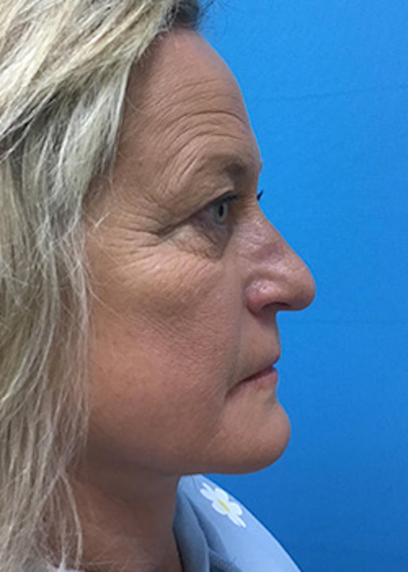 Fillers Before & After Gallery - Patient 148410555 - Image 5