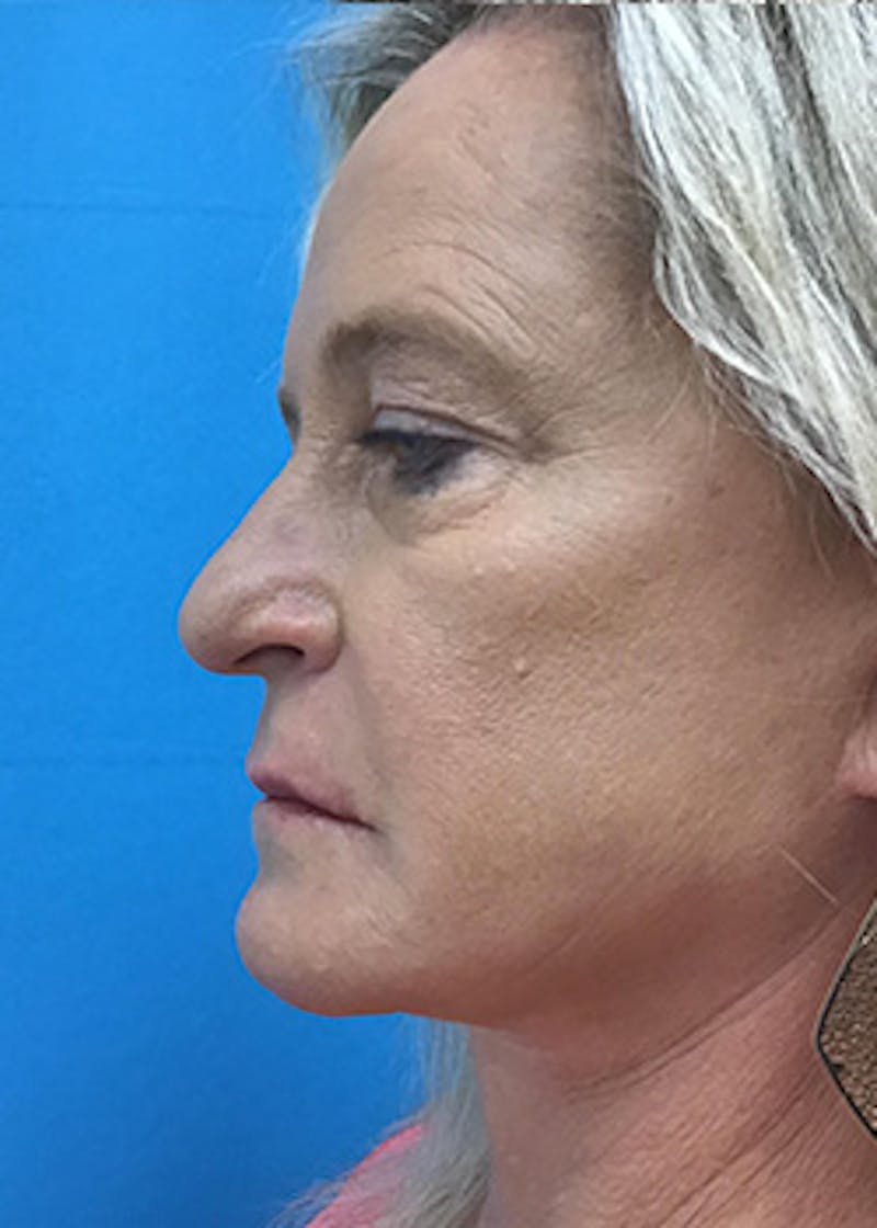 Fillers Before & After Gallery - Patient 148410555 - Image 10