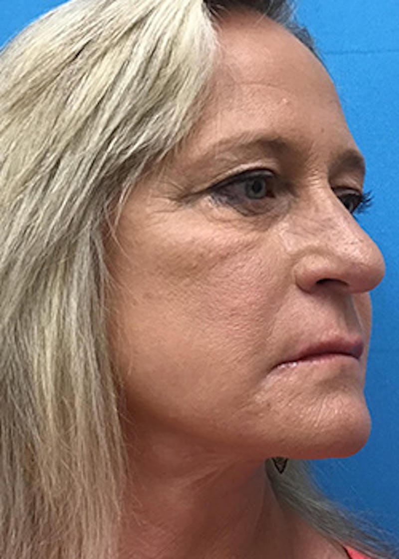 Fillers Before & After Gallery - Patient 148410555 - Image 4