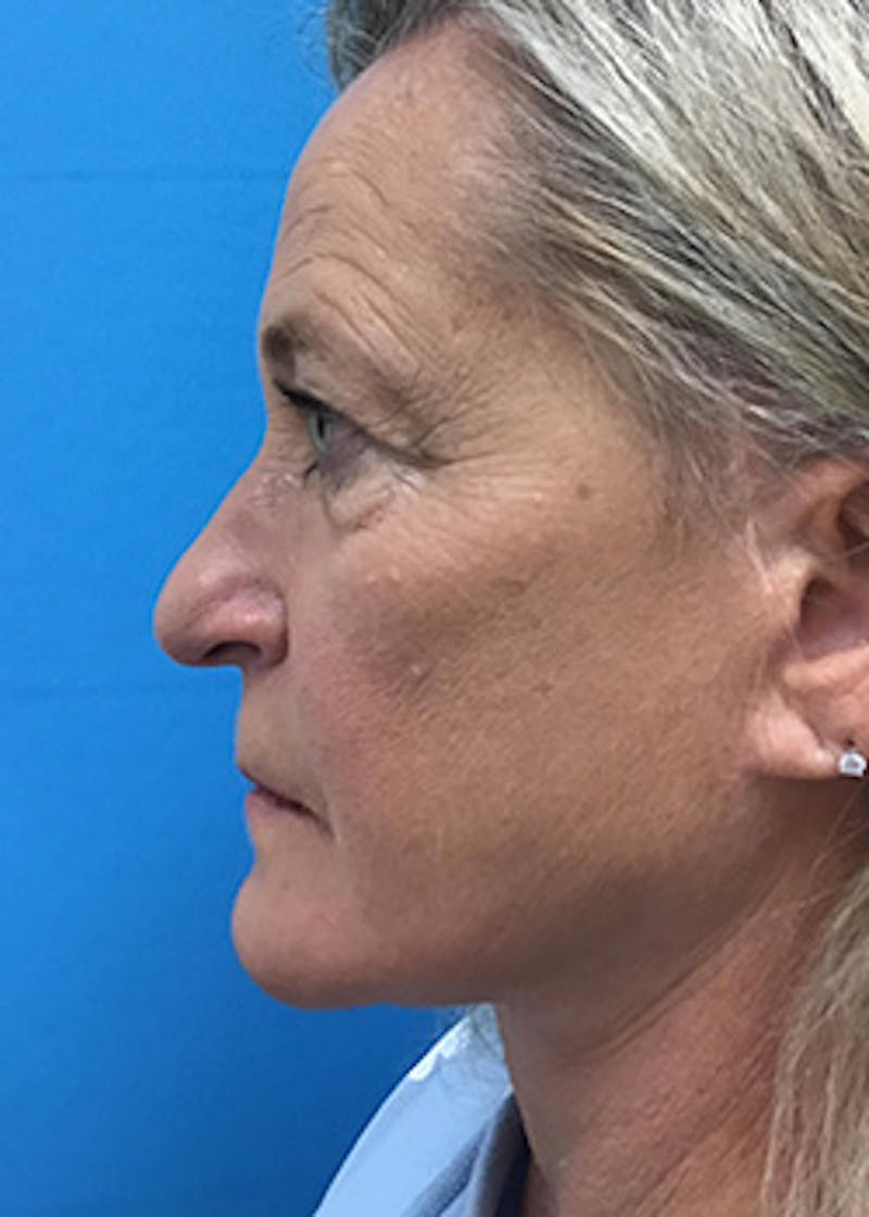 Fillers Before & After Gallery - Patient 148410555 - Image 9